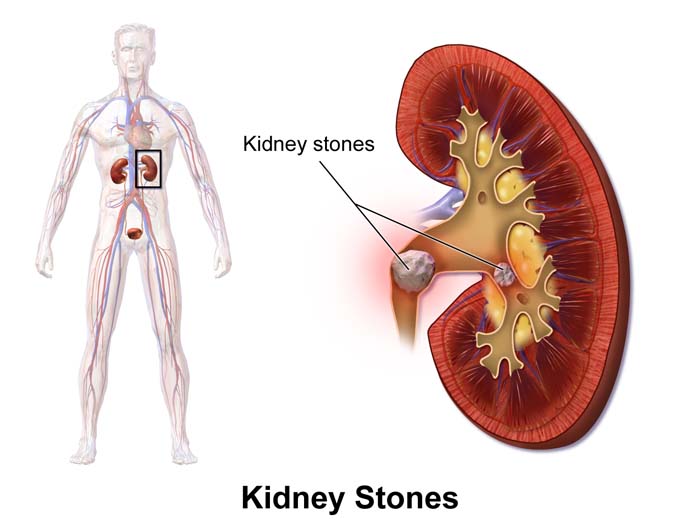 Stone in kidney