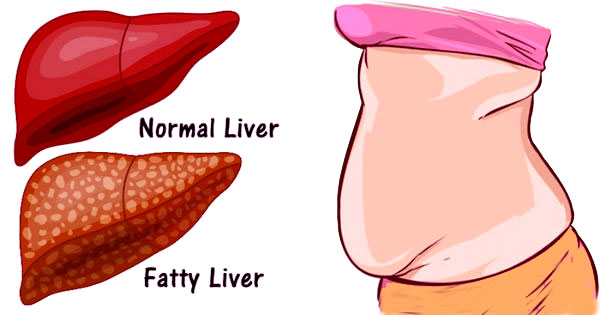 Fatty liver disease